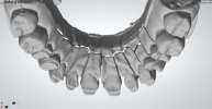 Preparation - upper jaw 1.png